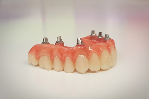 Tips To Extend The Longevity Of Implant Supported Dentures