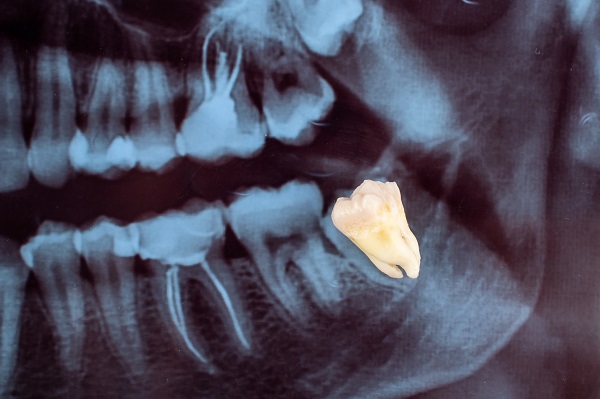 wisdom tooth extraction swelling
